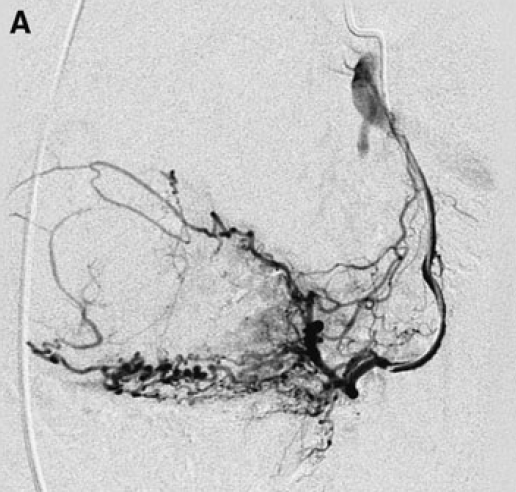 UFE Angiography Picture 1
