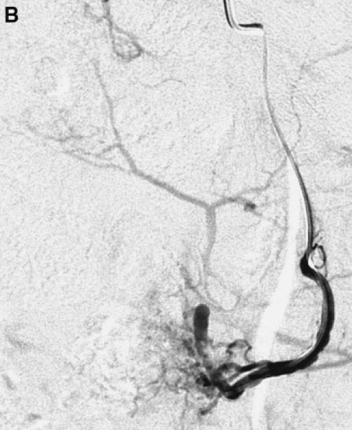UFE Angiography Picture 2