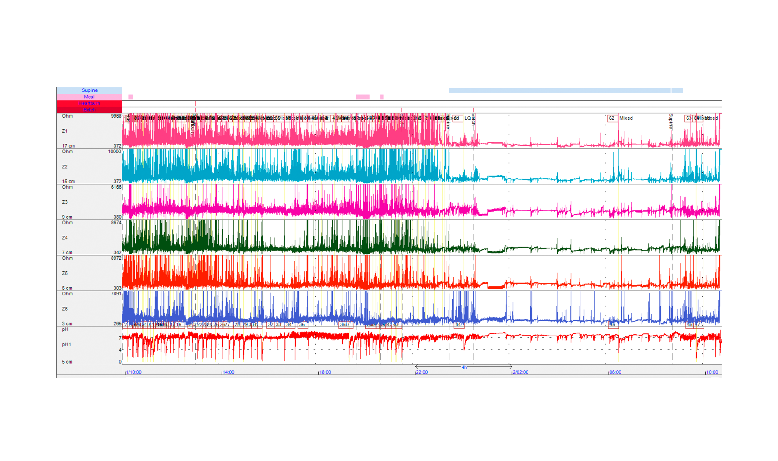 alpHaFLEX™ – Impedance-pH Monitoring System - Admedics Advanced Medical ...